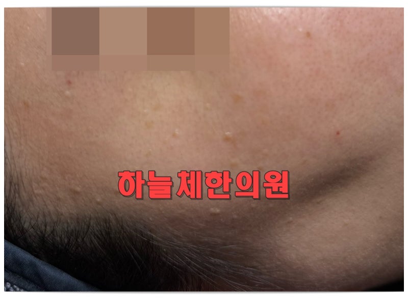 창원편평사마귀 제거, 얼굴에 여러 개라면 전부 같은 방법으로 없애야 할까요?