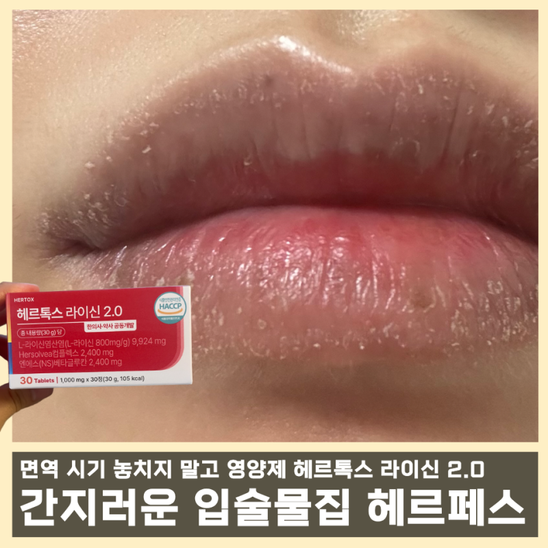간지러운 입술물집 헤르페스수포 재발 관리 영양제 추천, 전염성 대처법