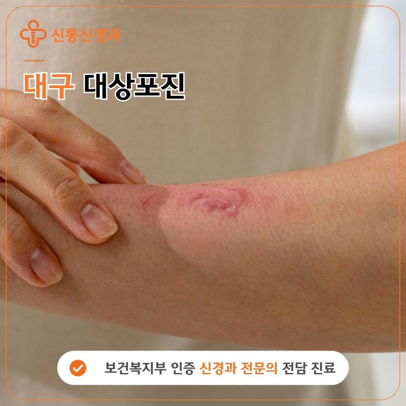 대구 달서구 대상포진 [진료과목 신경과] 대상포진이 의심되는 한쪽 통증과 물집은 언제 살....