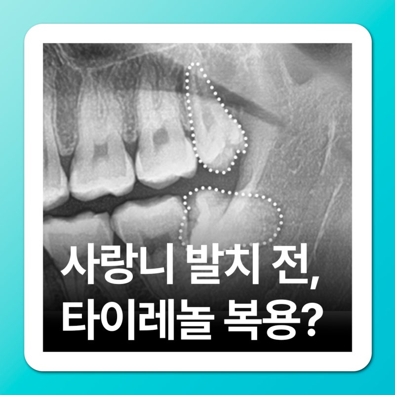 명륜동치과 사랑니 뽑기 전 타이레놀, 진통제 복용 타이밍은?
