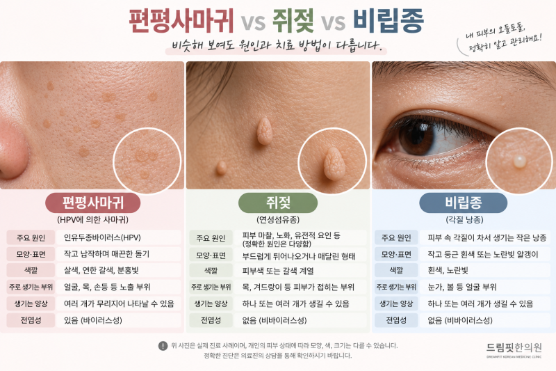 편평사마귀 vs 쥐젖 vs 비립종, 얼굴·목 오돌토돌 피부 돌기 구분법