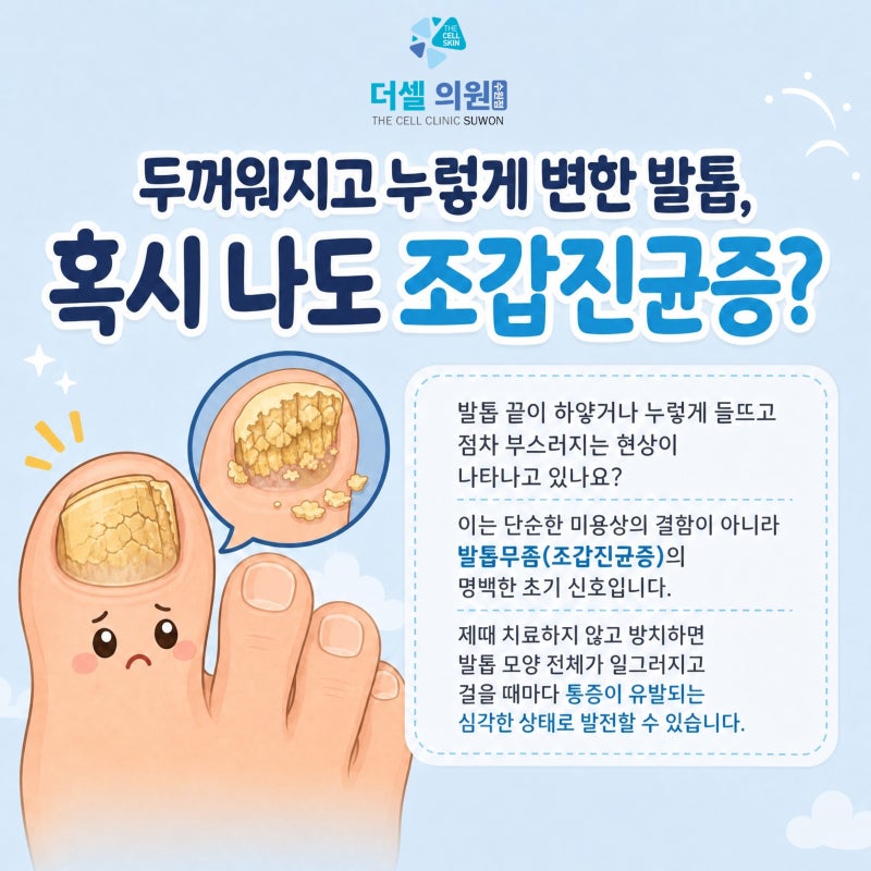 수원 무좀레이저, 오니코레이저 치료로 알아보는 조갑진균증 관리법