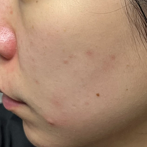 메디힐 마데카소사이드 마스크 팩 성분 효능 여드름 흔적 정리