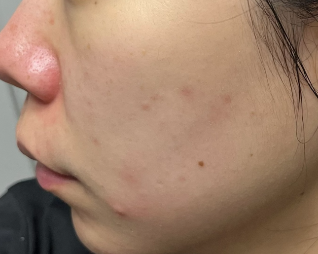 메디힐 마데카소사이드 마스크 팩 성분 효능 여드름 흔적 정리