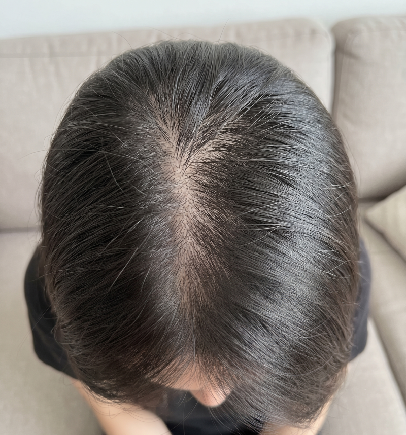 여성 탈모 영양제 추천 및 고를 때 주의할 점, 정수리 탈모 3개월 변화 부작용