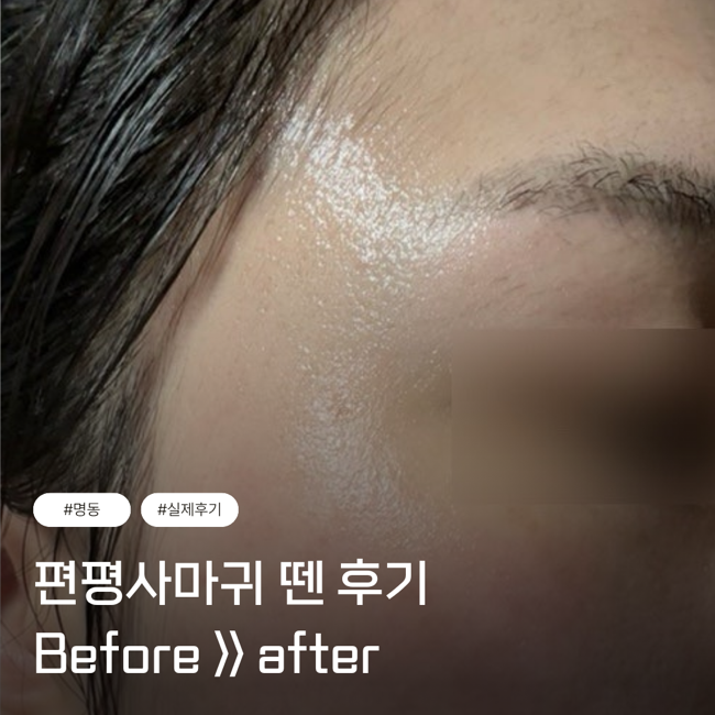 서울편평사마귀무제한제거 명동 성지