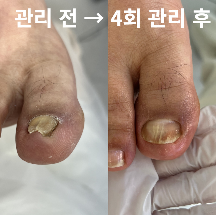 전주내성발톱, 병원?관리샵?뭐가 맞는걸까