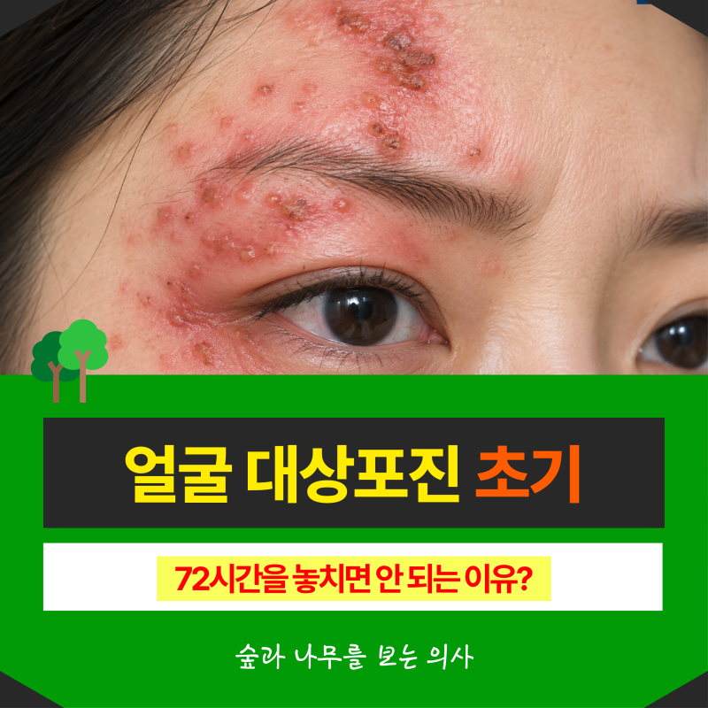 얼굴 대상포진 초기 72시간을 놓치면 안 되는 이유?
