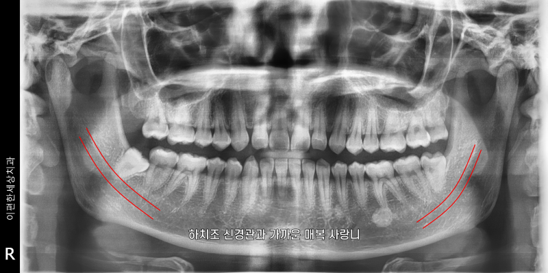 사랑니대학병원 꼭 가야 할까? 가까운 치과에서는 못 뽑는 걸까?