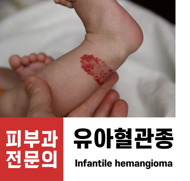 유아혈관종 (Infantile hemangioma)