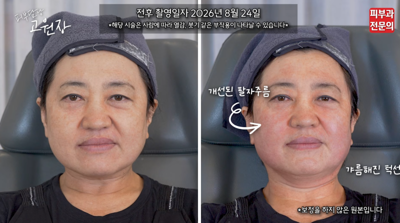 피부과전문의가 직접 알려주는 세르프 리프팅 효과, 세르프 후기, 세르프 가격, 세르프 통증....