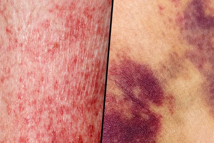 백혈병 Leukemia: 멍이 늘고 열이 났을 뿐인데, 골수에서는 전쟁이 시작되고 있었습니다
