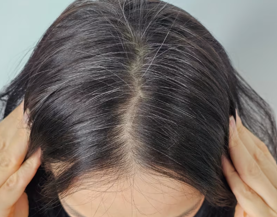 용혜인 흰머리 왜 이렇게 눈에 띌까? 30대부터 나는 이유