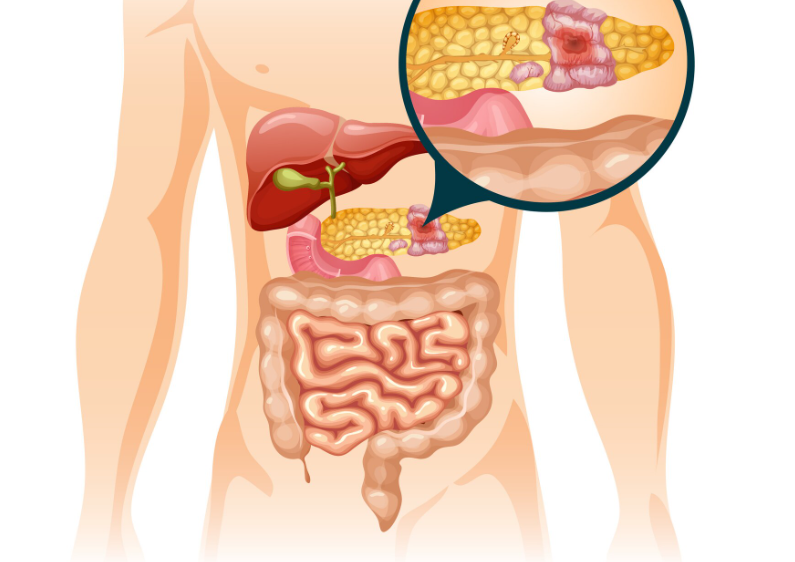 췌장암 치료제 신약 라손큐 FDA 승인 효능 및 약값