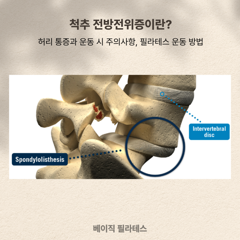 척추전방전위증이란? 허리 통증과 운동 시 주의사항, 필라테스 운....