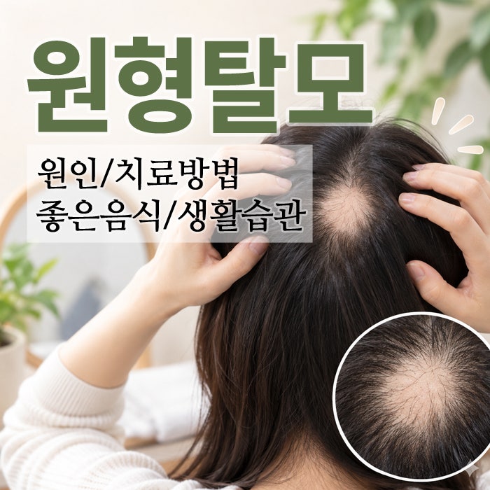 원형탈모에 대해 자세히 알아보기｜원인부터 치료방법·좋은 음식·생활습관까지