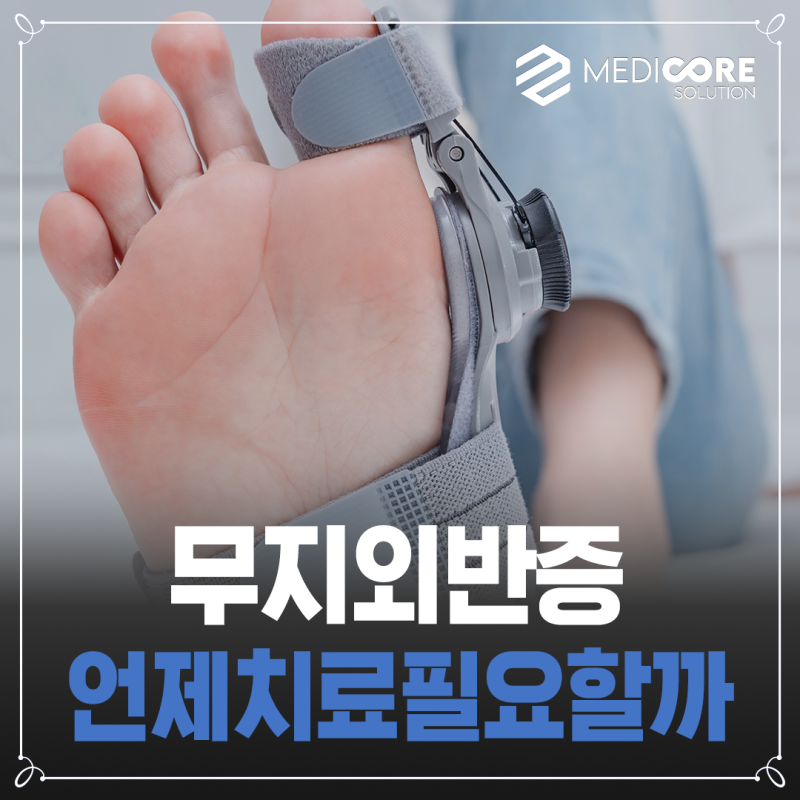 무지외반증 엄지발가락이 어느 정도 휘면 치료를 받아야 할까?