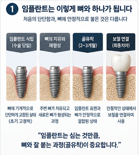 임플란트 심고 왜 2~3개월 기다릴까요?앞니는 당일 임시치아도 가능합니다