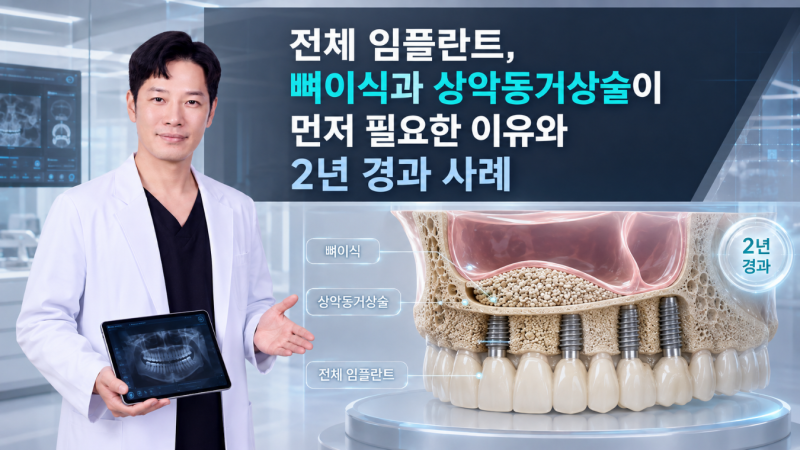 홍대 치과, 전체 임플란트, 치주염으로 녹은 잇몸뼈를 뼈이식과 상악동거상술로 되살린 2년 ....