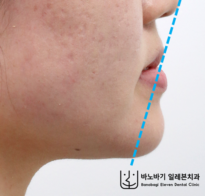 주걱턱 교정 치과 "아래턱이 얼마나 들어갈까요?" (비수술 주걱턱 교정 진료 후기)