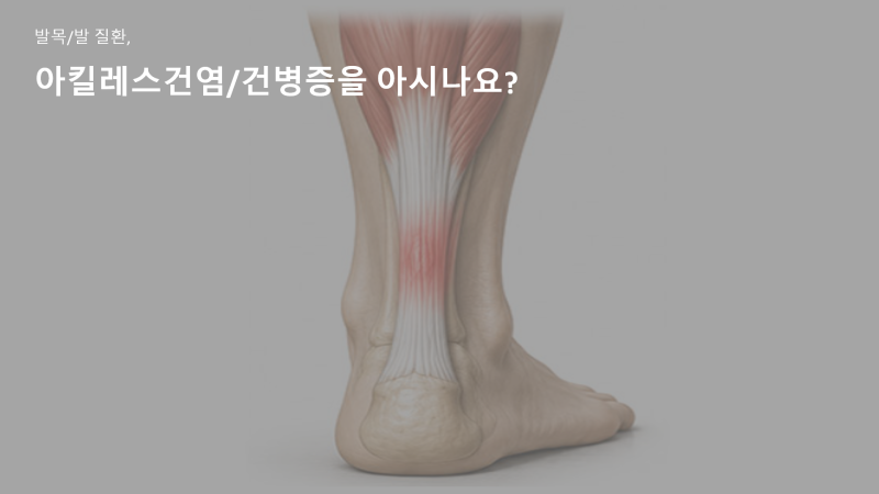 [범어,침산동재활피티PT]발목/발 질환 시리즈#5, 아킬레스건염(아킬레스건병증)