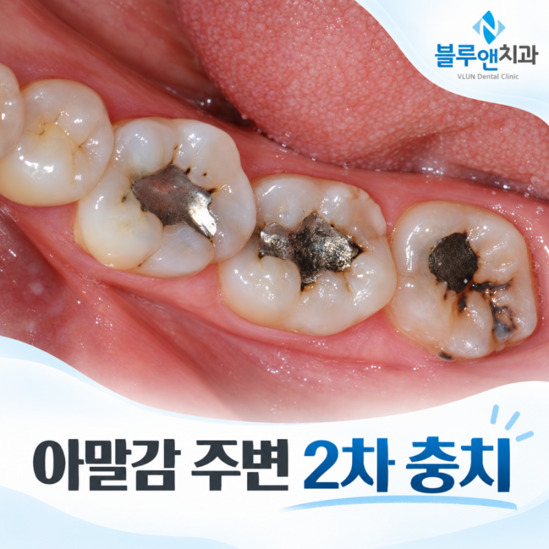 아말감교체 필요한 2차 충치, 앞니레진치료 까지 살펴본 사례