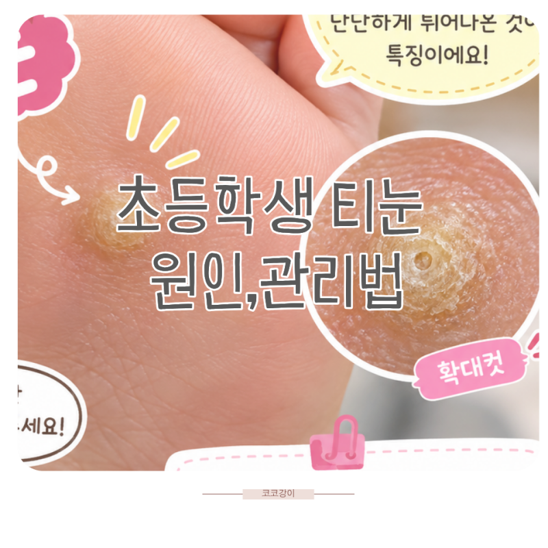 초등학생 티눈 생기는 이유와 집에서 관리할 때 알아둘 점