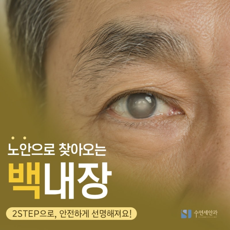 백내장 수술 가격 알아보다 인공수정체 이름부터 알게 되었어요