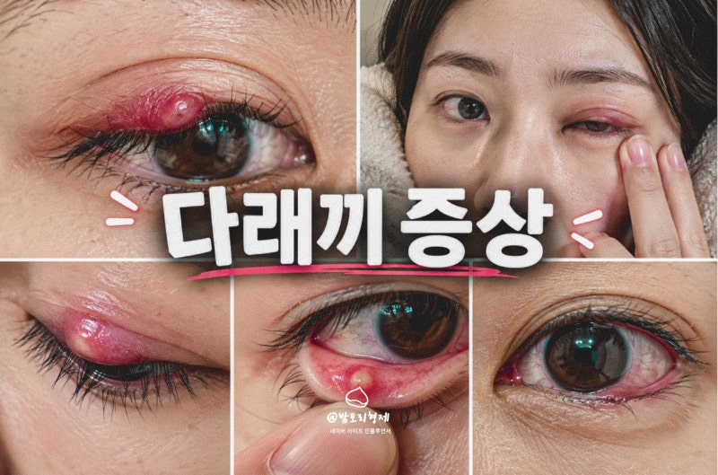 눈다래끼 원인 초기 증상 약 빨리 낫는법 전염될까?