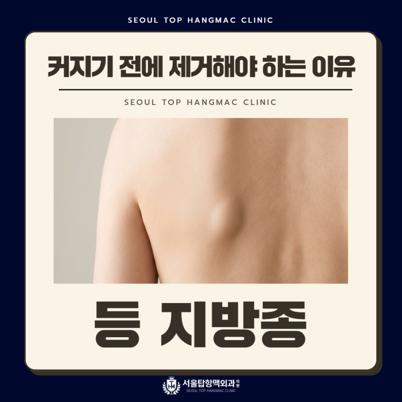 등에 생긴 지방종, 커지기 전에 제거하는 것이 좋은 이유