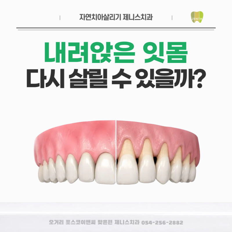 내려앉은 잇몸, 다시 살릴 수 있을까? 엠도게인 잇몸재생 치료