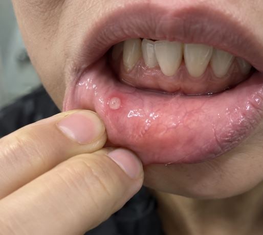 헥사메딘 가글 착색 고민이라면? 사용법 제대로 알고 쓰세요 (부작용까지 정리)