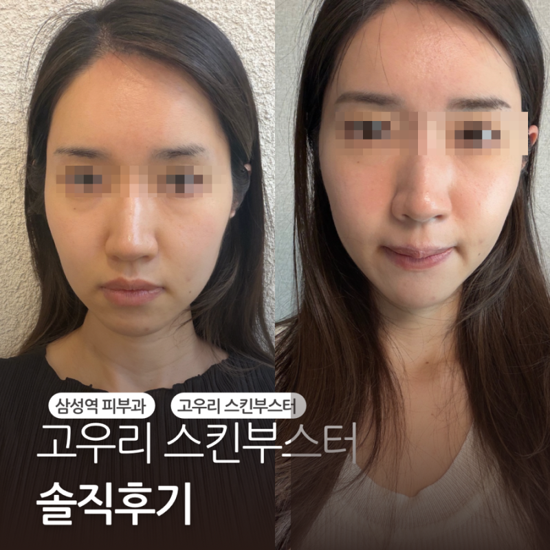 삼성역 고우리 스킨부스터 1회차 시술 후기
