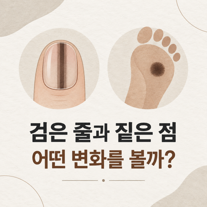 악성 흑색종 차이, 손톱 발톱 발바닥 흑색종 어떻게 다를까