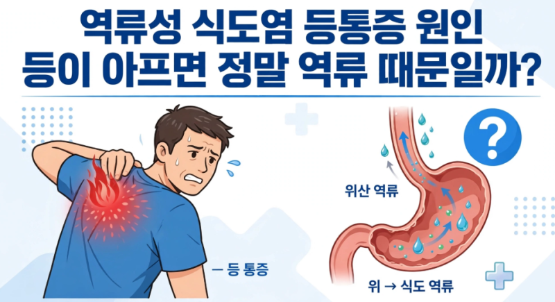 역류성 식도염 등통증 원인, 등이 아프면 정말 역류 때문일까?
