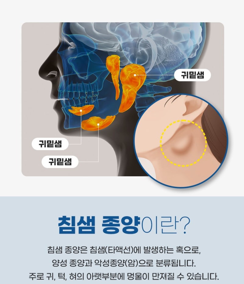 "턱 아래가 볼록해요" 침샘종양 증상, 종양이 양성인지 악성인지 어떻게 구별하나요?