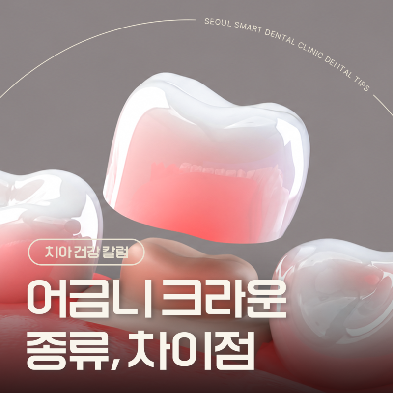 어금니 치아 크라운 3가지 종류 골드 PFM 지르코니아 차이점?