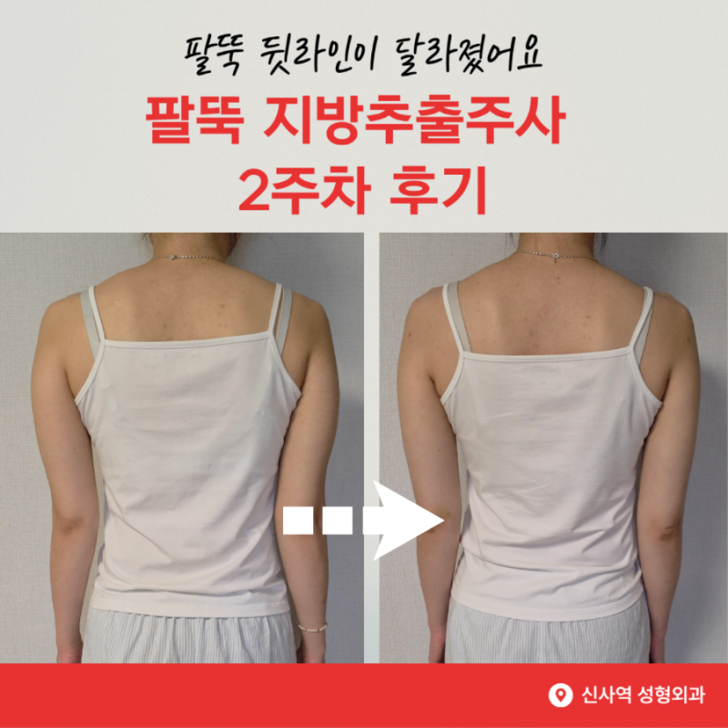 강남 팔뚝지방추출주사 2주차 후기 운동으로도 안 빠졌던 팔뚝