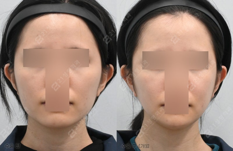 얼굴선 깎기 전에, 후회 안 하려면 꼭 알아야 할 것들(사각턱 · 광대 · 턱끝 A to Z)