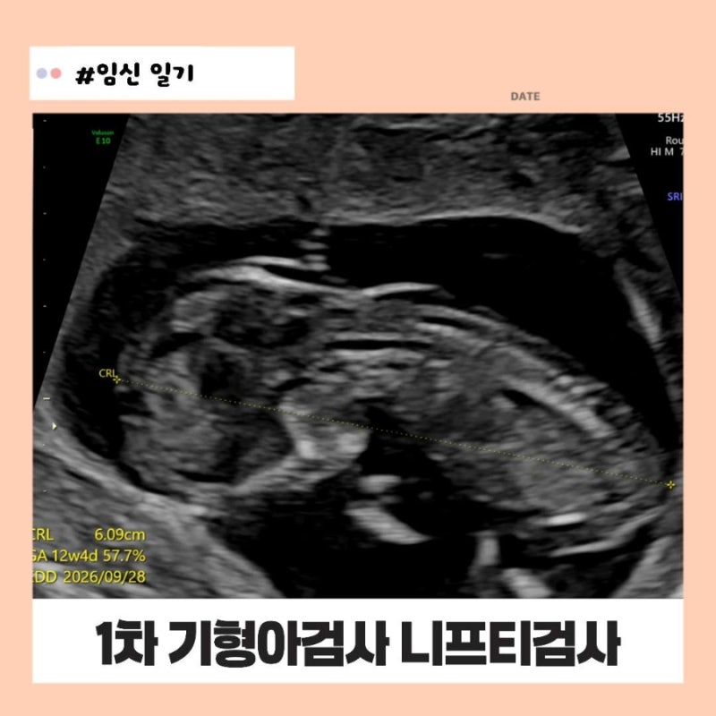 임신 9주차 12주차 젤리곰 1차 기형아 검사 니프티 검사