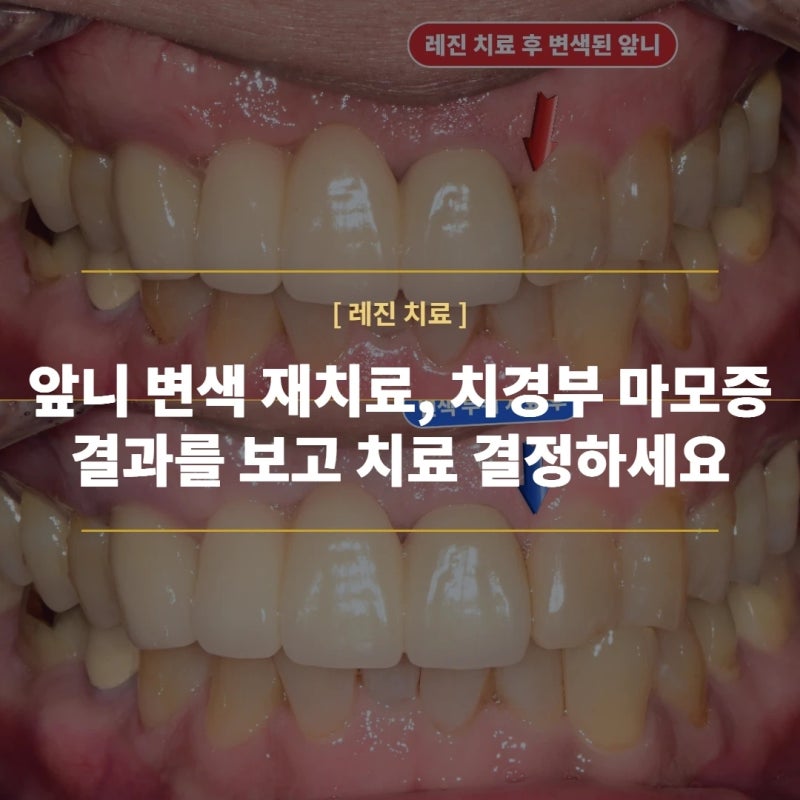치경부 마모증, 앞니 레진 변색 / 레진 치료는 결과를 확인할 수 있는 곳에서 치료 받으세요