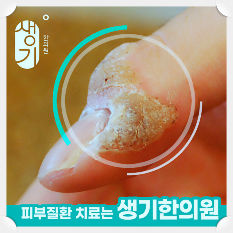 손 사마귀 입으로 물어뜯거나 손톱깎이를 쓰지 말라고 하는 이유