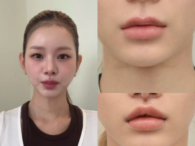 맹승지 인중축소수술 후기…인중수술, 누가 하면 좋을까?
