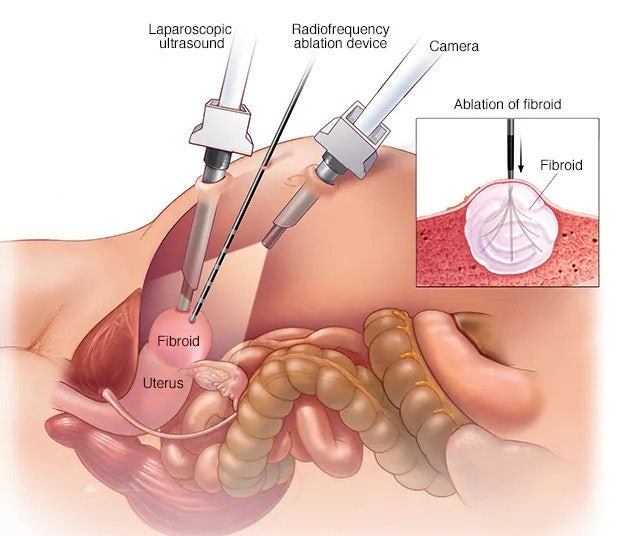 자궁근종 Uterine Fibroids/Myoma: “자궁을 들어내야 합니다.” 그 말밖에 없던 시대에서, 자궁을 ....