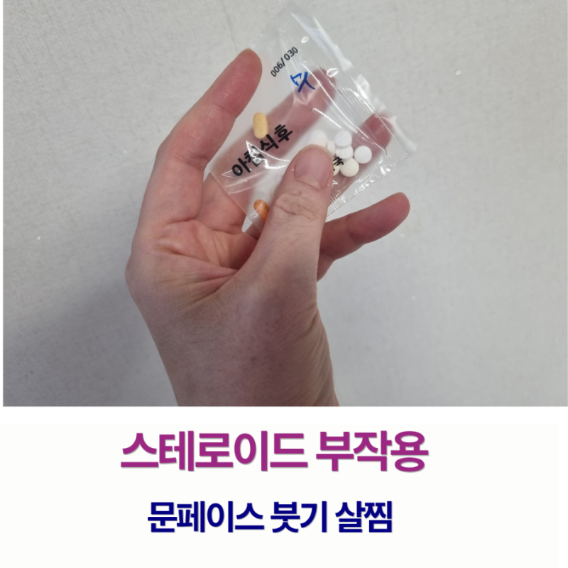 고용량 스테로이드 부작용 경험담 문페이스 살 붓기 불면증 소론도정