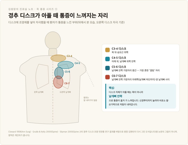 목디스크 증상, 팔저림이면 다 디스크일까 — 신경근병증 진단과 치료 (목 통증 시리즈 ①)