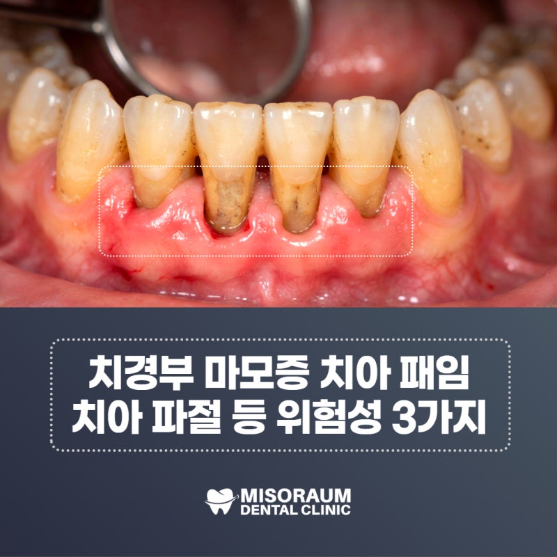치경부 마모증 치아 패임 방치 시, 치아 파절 등 위험성 3가지