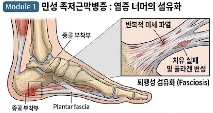 [안산 족저근막염 한의원] 아침 첫발 디딜 때 뒤꿈치 통증, 여러 치료로도 낫지 않는다면? (후....