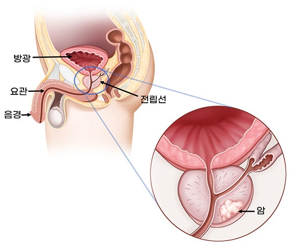 전립선암 검진에 대한 6가지 일반적인 오해