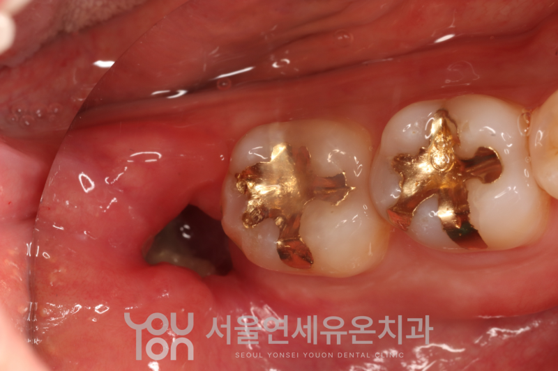 여의도 사랑니 발치, 사랑니 뽑은 후 구멍은 언제 메워질까요? 뽑은 뒤의 치유가 더 중요합니....